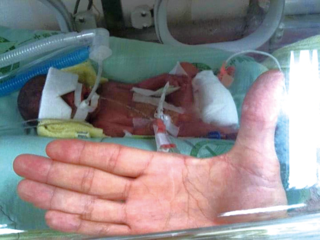 張愷伯大女兒出生只有手掌般的大小。